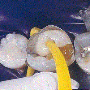 Восстановление культи зуба